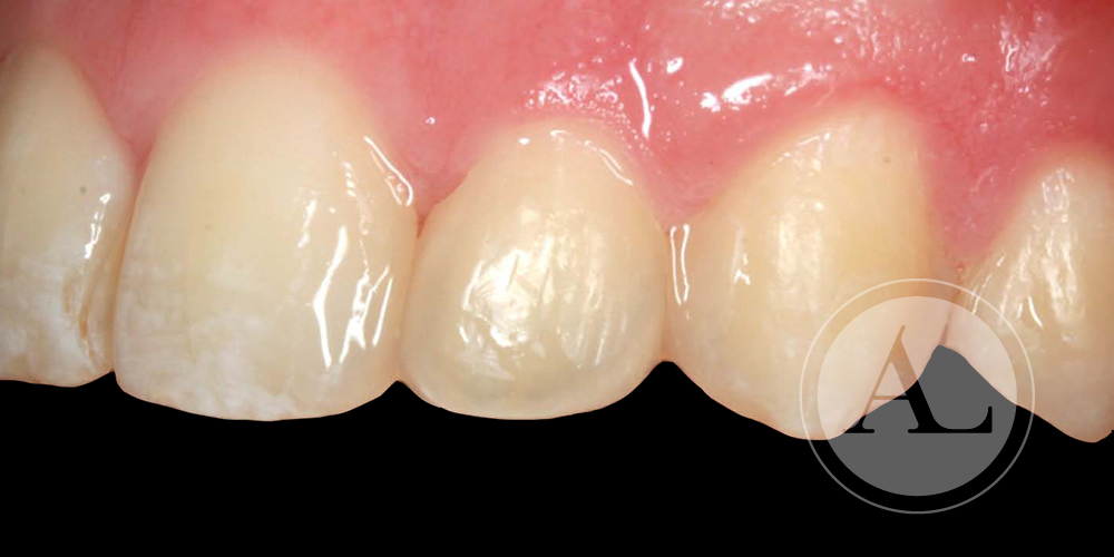 microestética dental Ortodoncia en adulto
