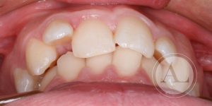 Ortodoncia en adulto Clínica Dental Antonio Lucena