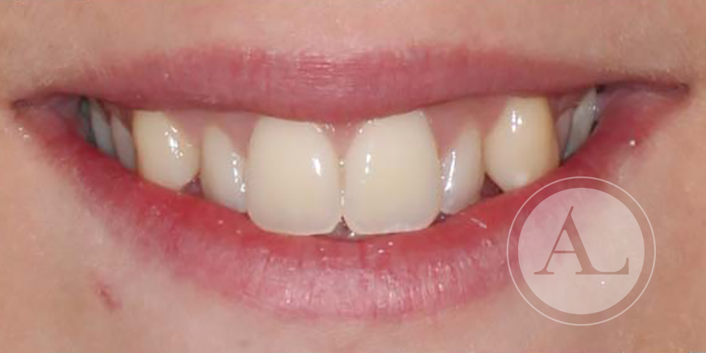 Solución a apiñamiento dental en Clínica Antonio Lucena