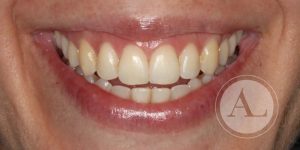 Estética dental clínica dental Antonio Lucena