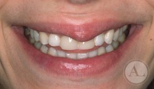 estetica-dental-carillas1