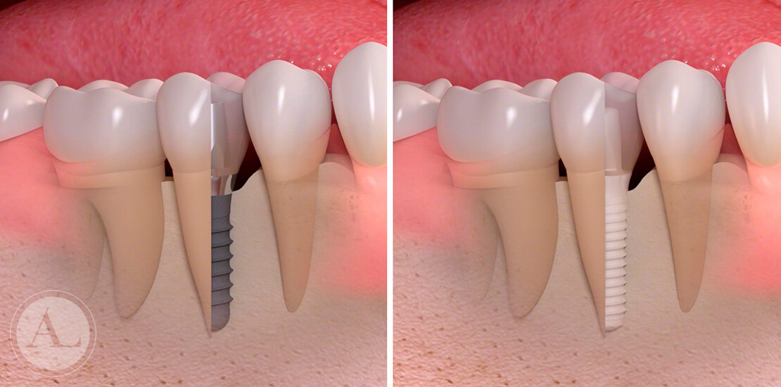 implantes-dentales-straumann-2