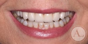 clinica-Cordoba-coronas+blanqueamiento-dental