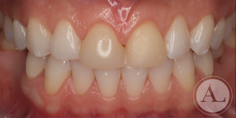 clinica-dental-Cordoba-carillas-porcenala-1