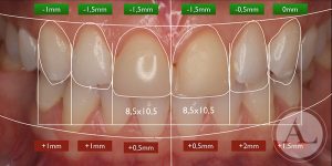 clinica-dental-Cordoba-carillas-porcenala-2