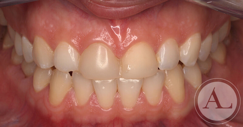 clinica-dental-Cordoba-carillas-porcenala-intraoral-antes