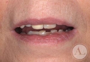clinica-dental-Cordoba-coronas+blanqueamiento-antes