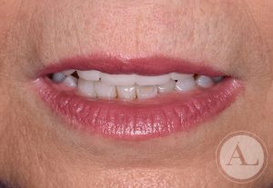 clinica-dental-Cordoba-coronas+blanqueamiento-despues