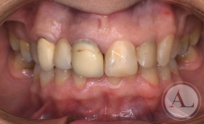 clinica-dental-Cordoba-coronas+blanqueamiento-intraoral-antes