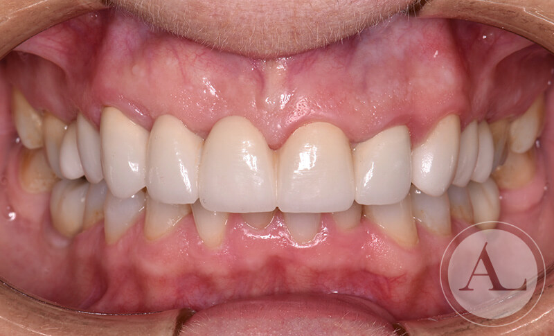 clinica-dental-Cordoba-coronas+blanqueamiento-intraoral-despues