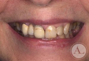 clinica-dental-Cordoba-coronas+blanqueamiento-sonrisa-antes