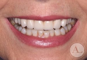 clinica-dental-Cordoba-coronas+blanqueamiento-sonrisa-despues