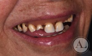 clinica-dental-Cordoba-protesis-completa-antes