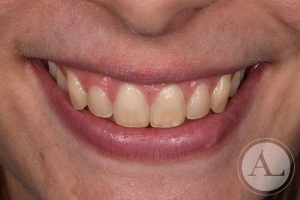 dentista-Cordoba-blanqueamiento-dental-antes