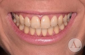 dentista-Cordoba-blanqueamiento-dental-antes