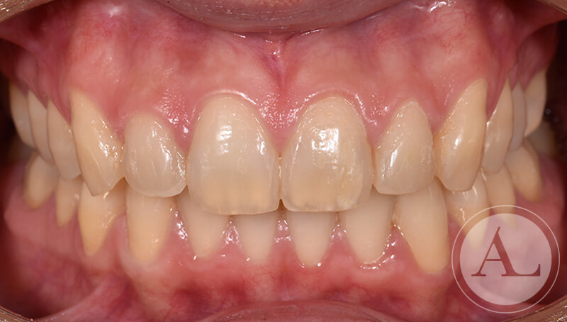 dentista-Cordoba-blanqueamiento-dental-intraoral-antes