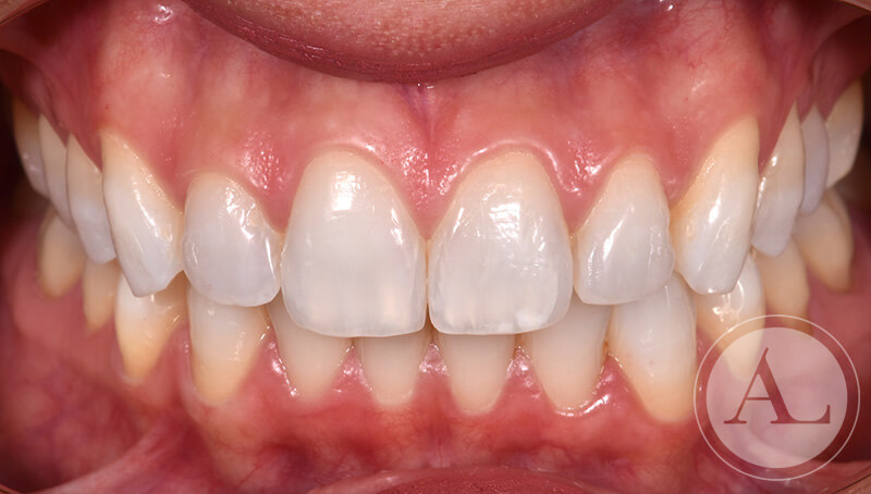 dentista-Cordoba-blanqueamiento-dental-intraoral-despues