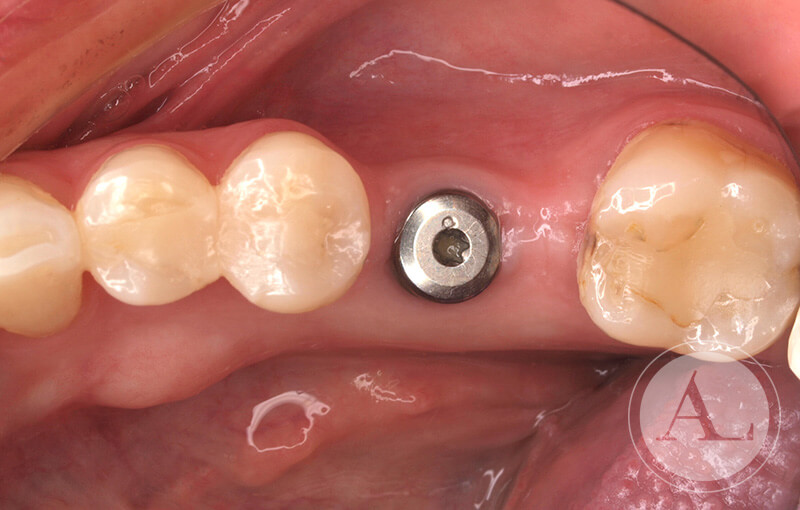 implante-dental-cordoba-vista-superior-antes