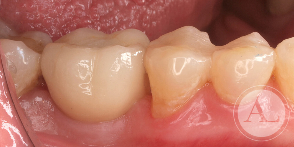 implante-dental-cordoba